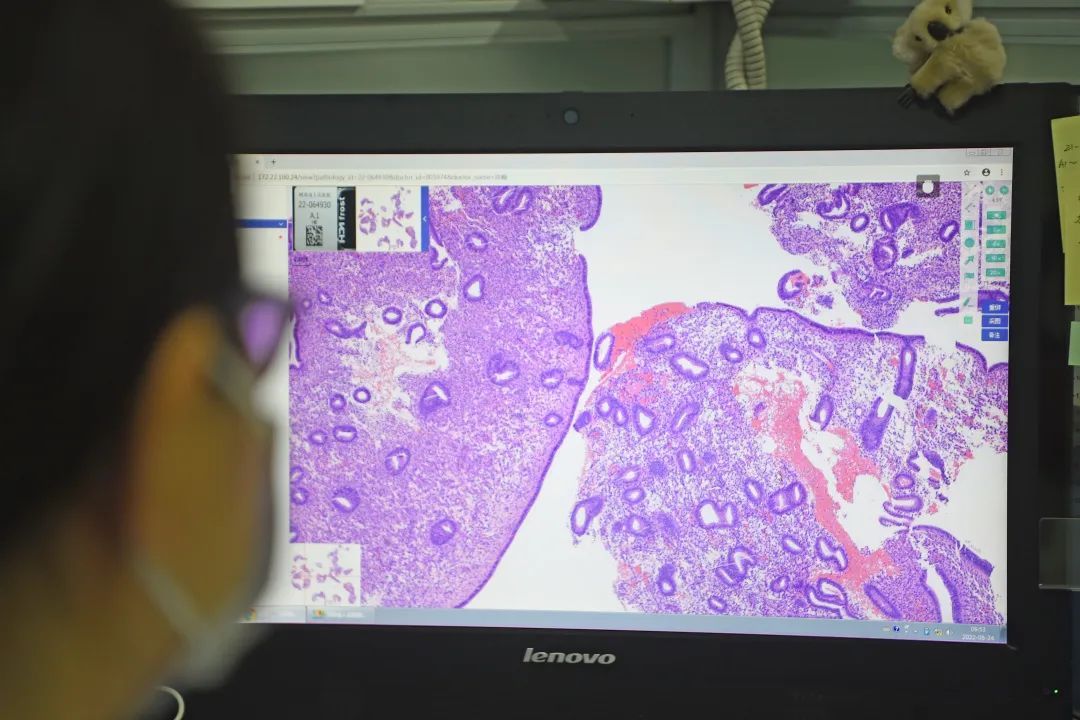 医生说病理报告有点小问题,病理报告没出来好害怕啊