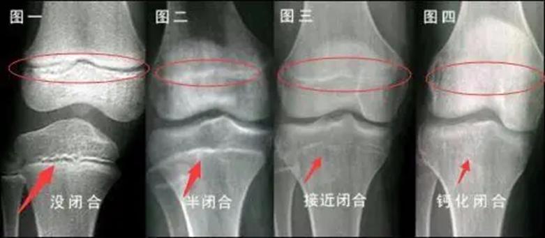 孩子出现这三种情况快速长高,千万别错过孩子长高的关键期