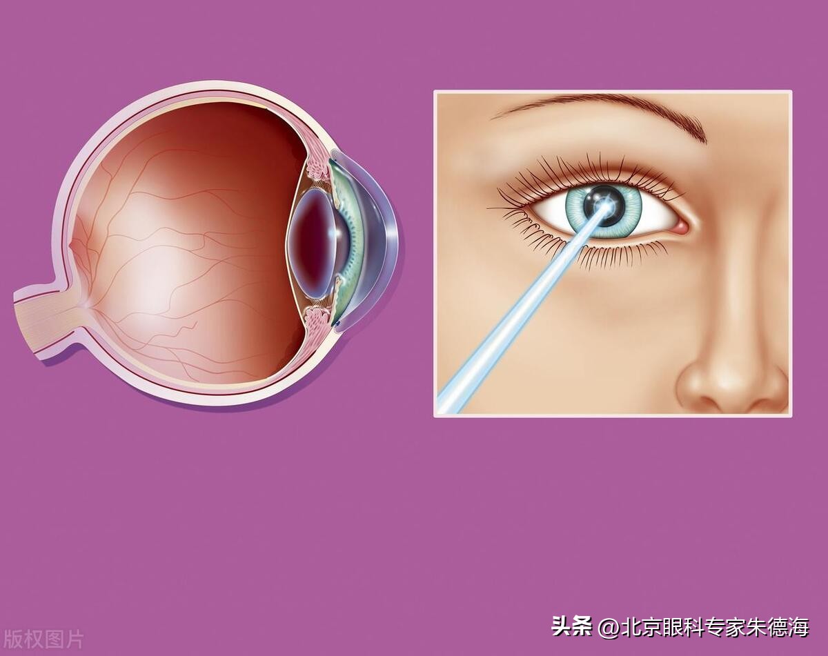 激光矫正近视和散光有什么后遗症,激光治疗近视散光有什么后遗症