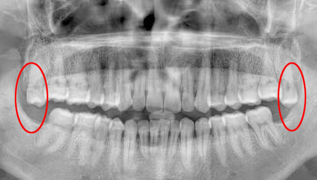 智齿是什么为什么人要长智齿,什么是智齿为什么会长智齿图片