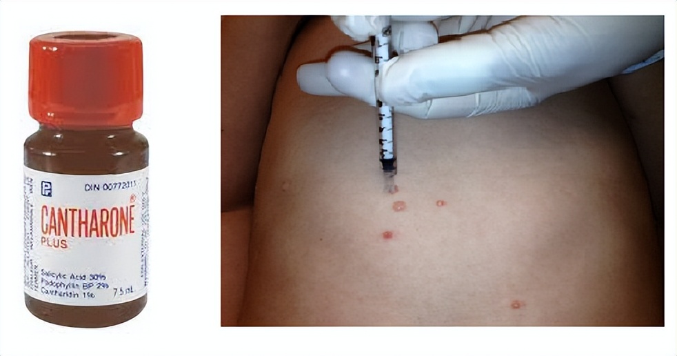 为什么小孩有那么多痘痘,儿童痘痘的最佳治疗方法