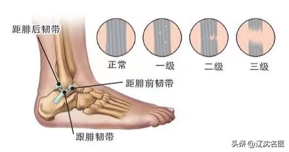 崴脚不重视当心出现后遗症,崴脚处理不及时会导致习惯性崴脚