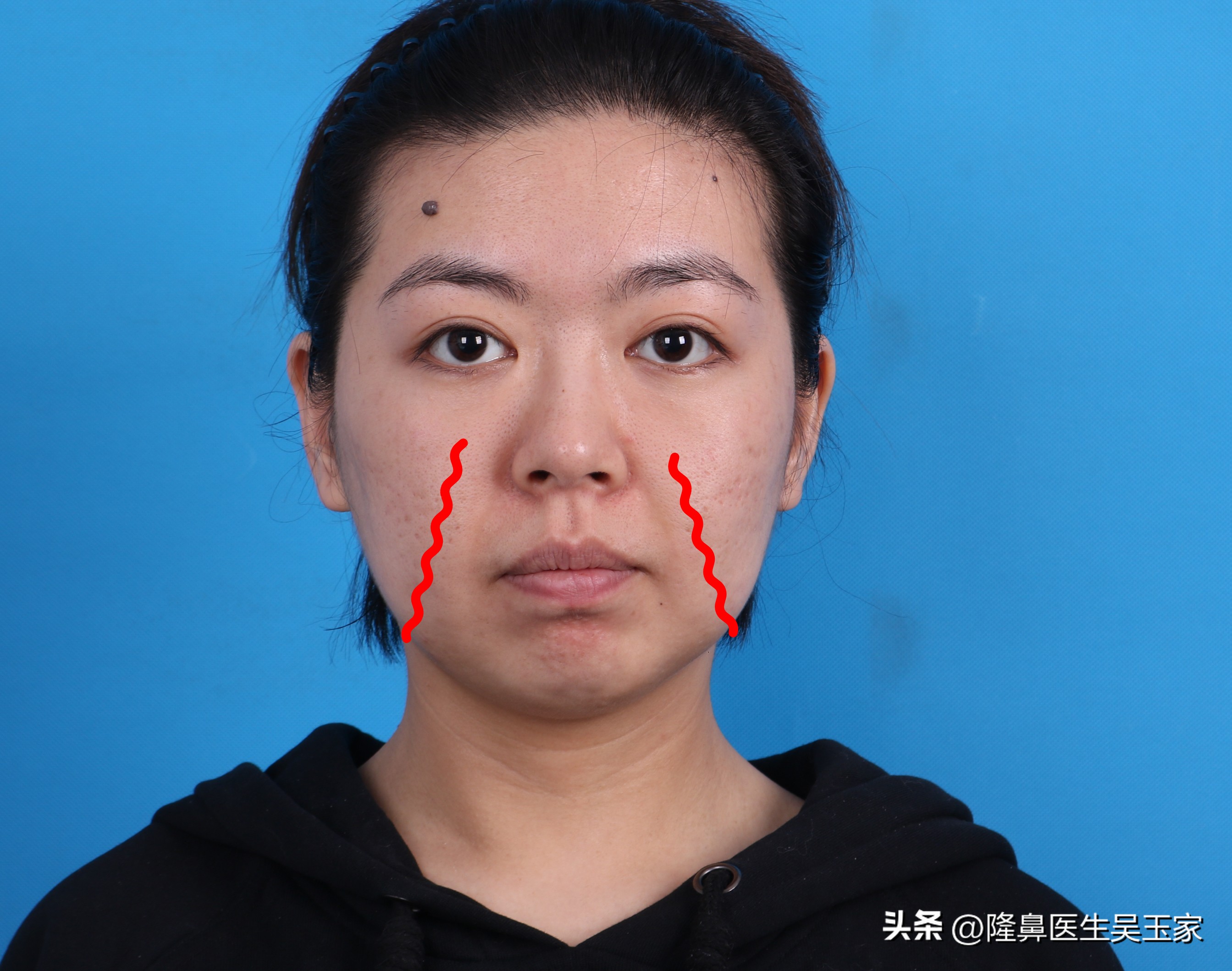 35岁去法令纹用哪个产品,去鼻纹最好的方法是什么