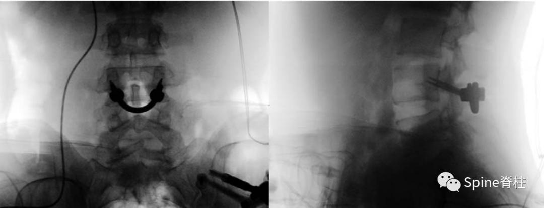 轻度峡部裂和重度峡部裂的区别,真性峡部裂和假性峡部裂