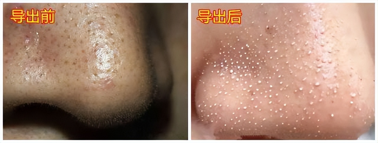 真黑头假黑头傻傻分不清楚，怎么去黑头？