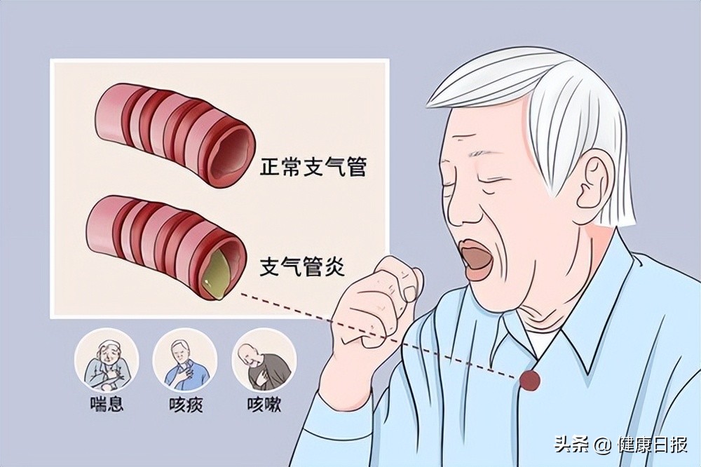 支气管发炎怎么好得快,支气管发炎有什么食疗的方法