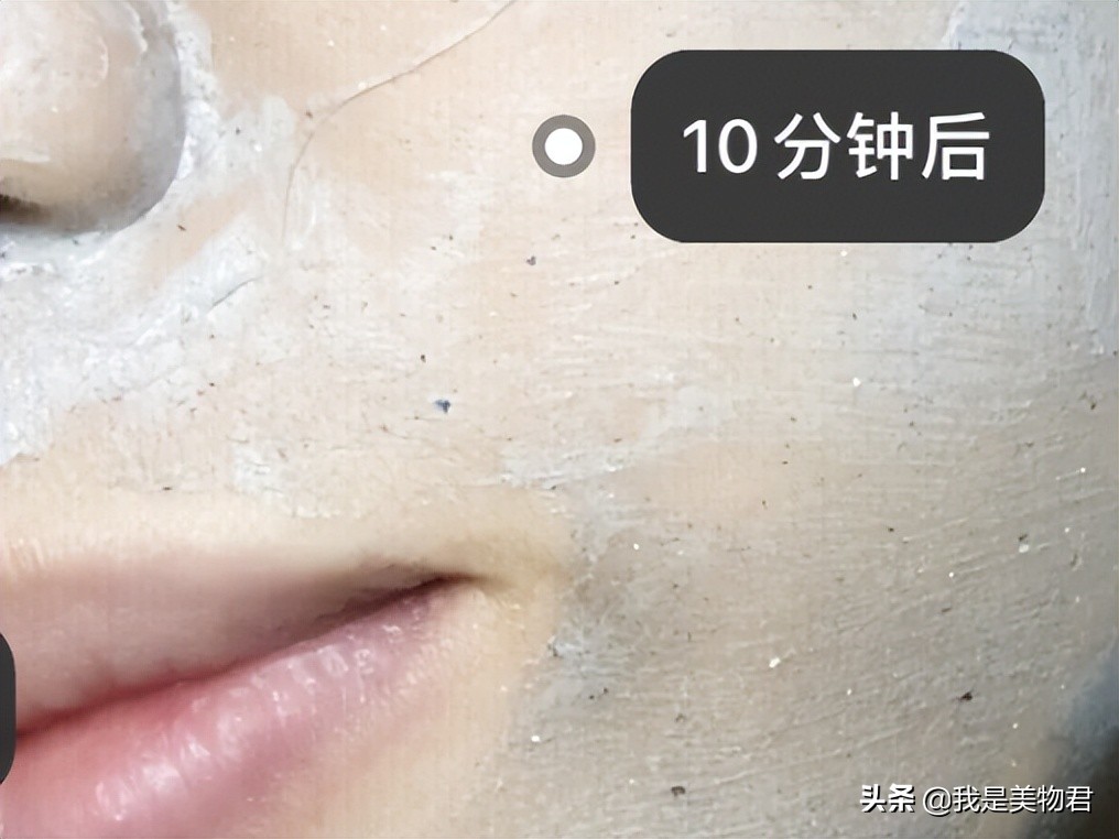 毛孔堵塞闭口粉刺怎么去除最有效,毛孔堵塞闭口粉刺怎么消除