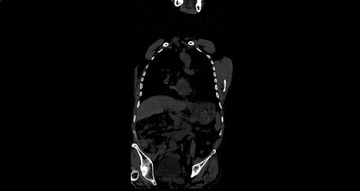 如何判断自己是腰肌劳损还是强直,腰腿疼痛是不是跟腰肌劳损有关系