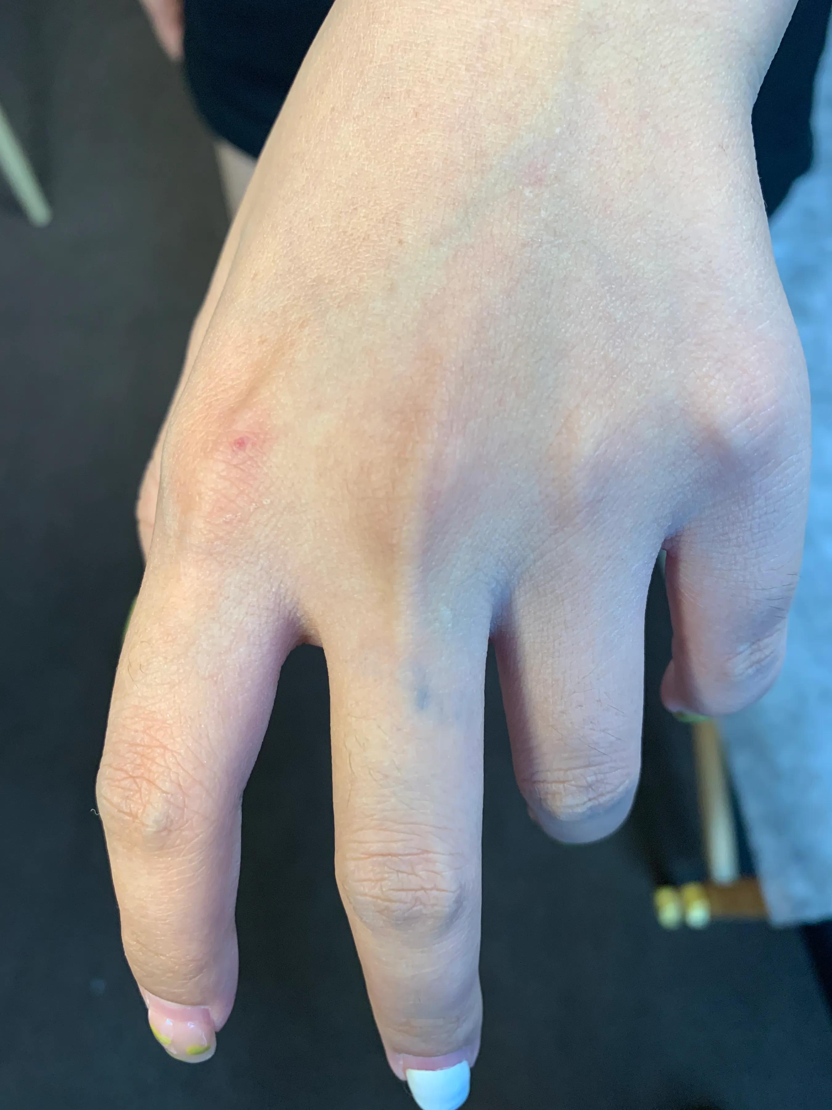 深圳清洗纹身哪家专业,推荐深圳专业洗纹身