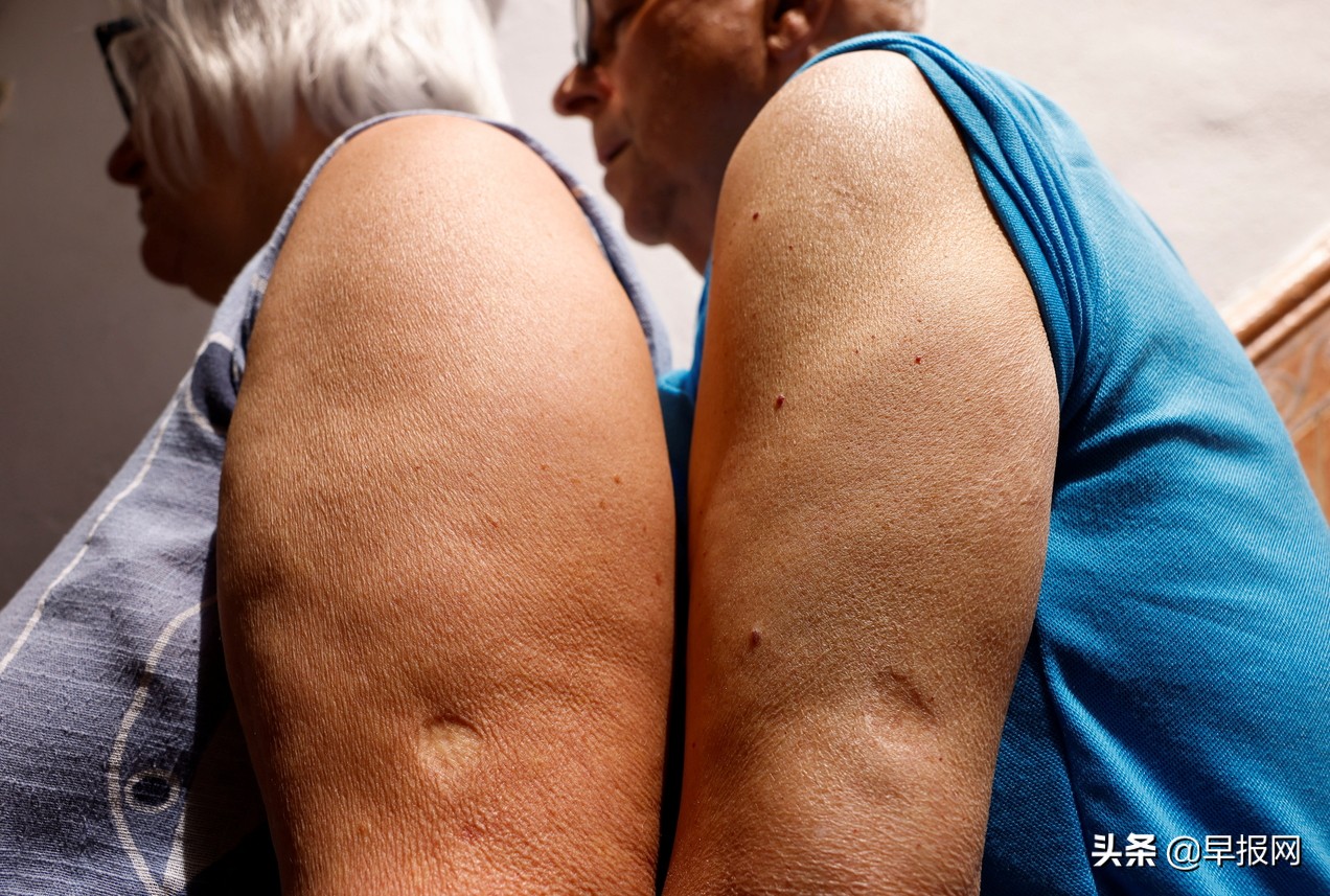 国际特稿：从非洲到欧美猴痘症可控吗？