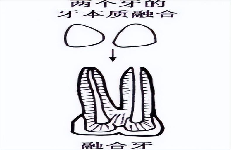 连体畸形牙齿,牙齿有重叠部分可以把牙齿磨小吗