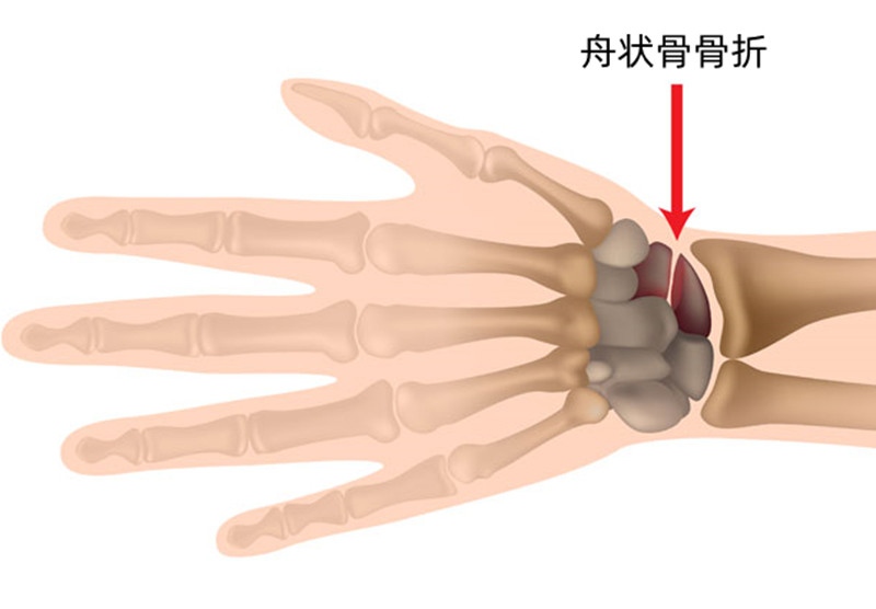 脚踝骨折和脚趾骨折怎样做康复,手腕骨折和脚踝骨折哪个严重