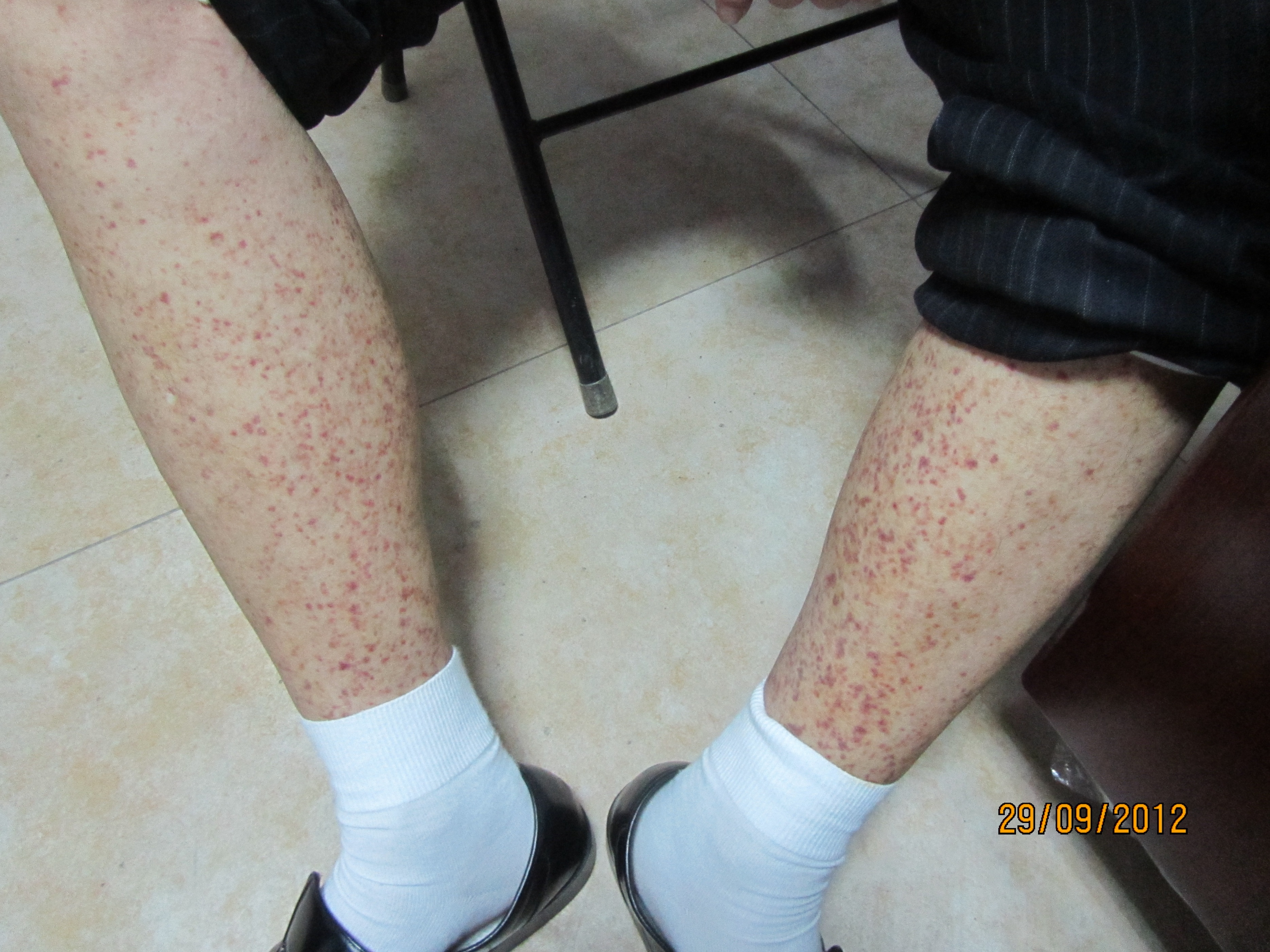 手上有红色的小点点过敏性紫癜,腿上有小红点皮下出血