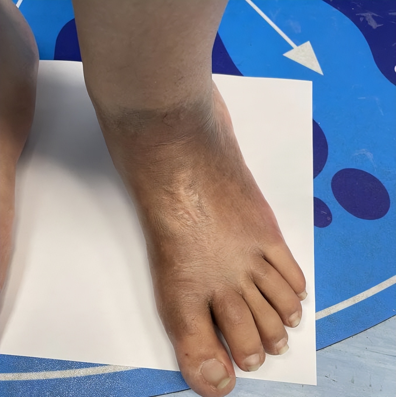 脚底板血管瘤介入治疗,脚底弥漫海绵状血管瘤