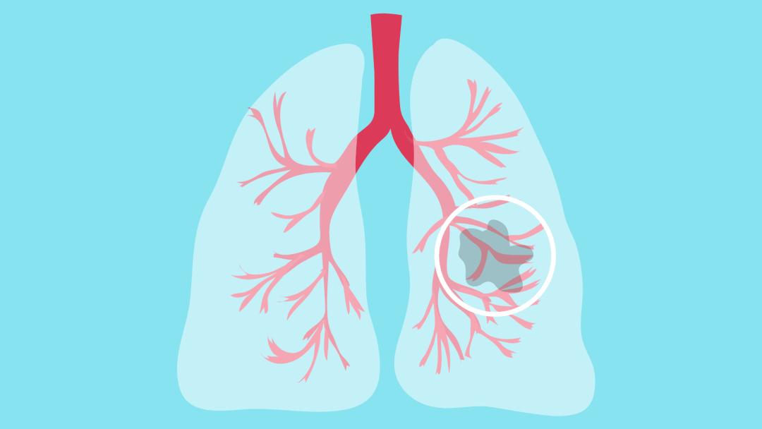 一查竟有两种癌,一查出来就是恶性肿瘤