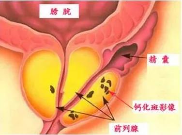 泌尿董博士,体检医生说前列腺钙化咋回事啊