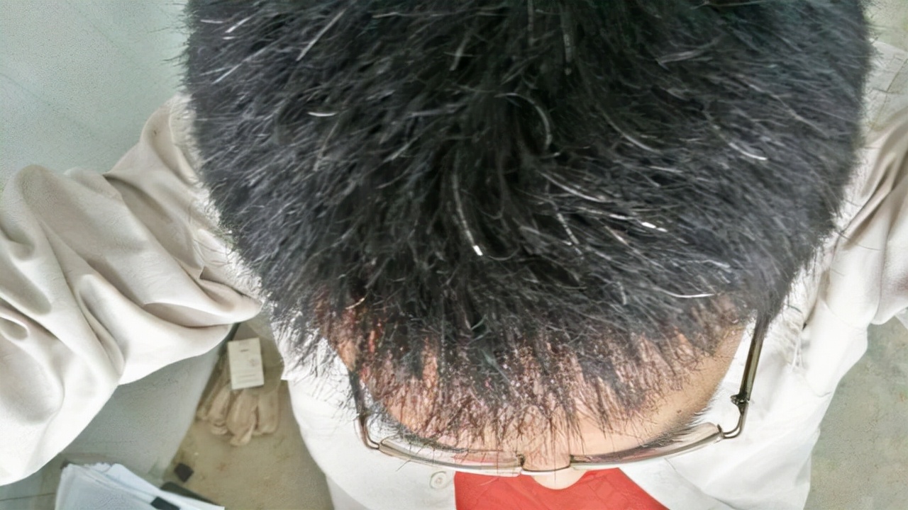 白发在头顶长代表什么,白发长在额前多是什么原因