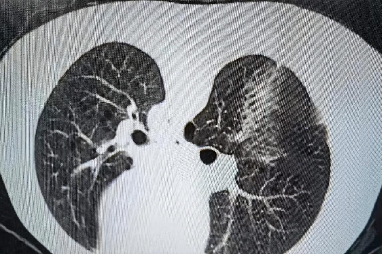 经皮肺活检术,经皮环肺静脉射频消融术名词解释