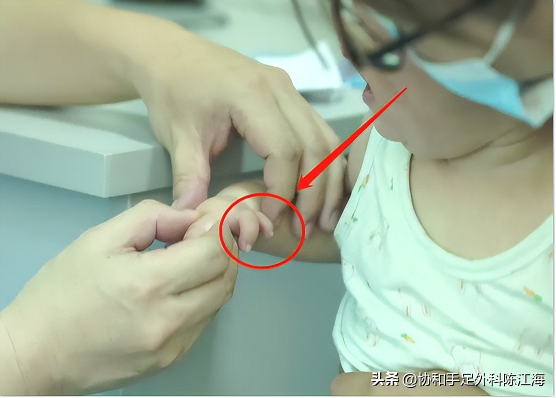 宝宝拇指有两个，都悬挂不能动，父母四处求医，只为还原孩子五指