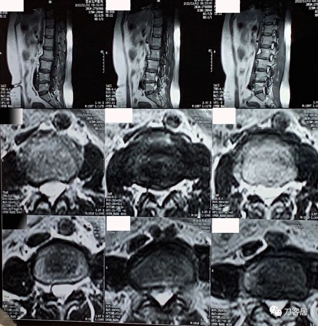 感染新冠左侧腰腹抽痛,腿酸疼是新型冠状病毒怎么治疗
