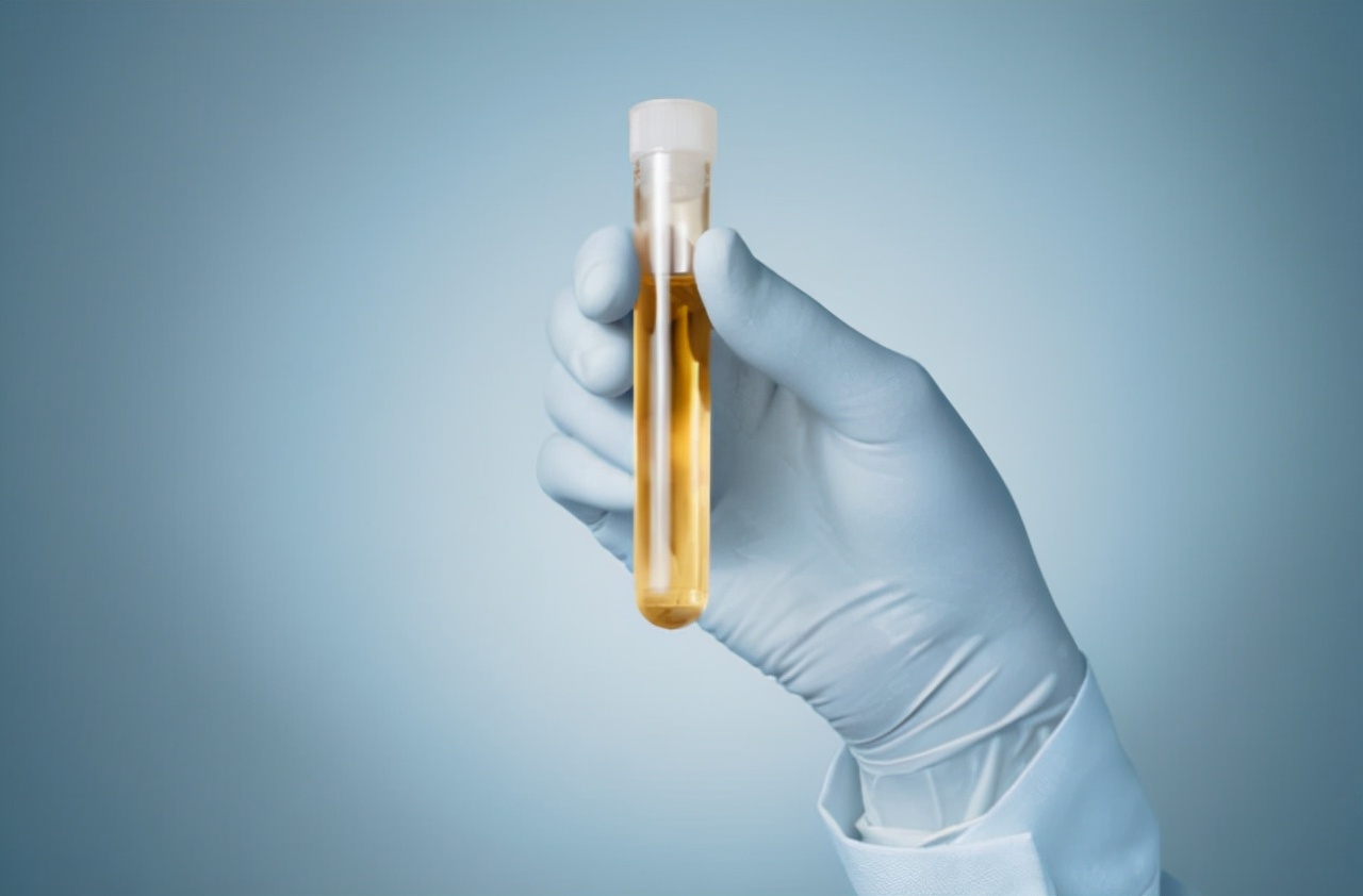 上厕所尿液特别黄怎么回事,上厕所时尿液很黄怎么回事