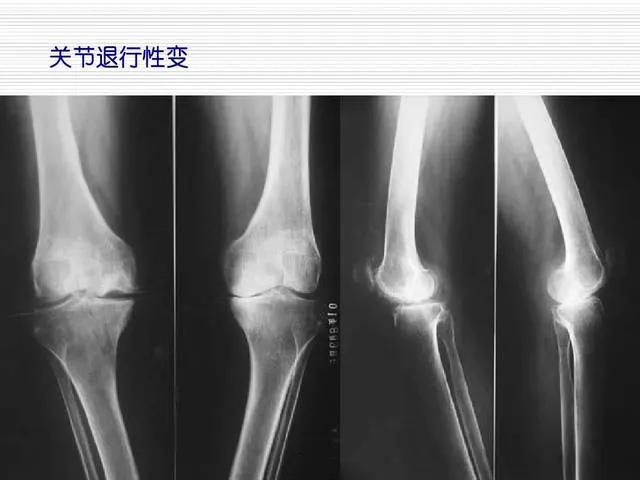 60岁大妈膝盖关节疼能治好吗,大妈总是膝盖疼是什么原因