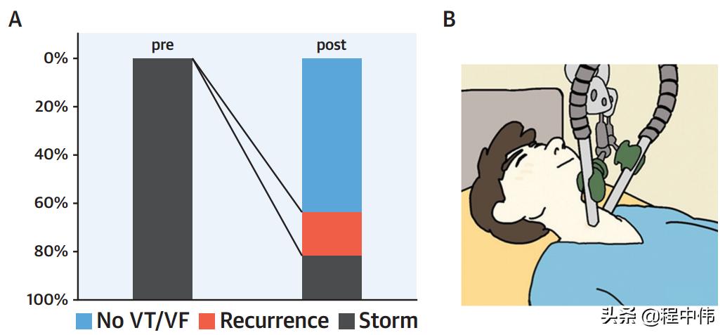 星状神经节阻滞治疗癫痫,星状神经节阻滞治疗心脏神经官能症