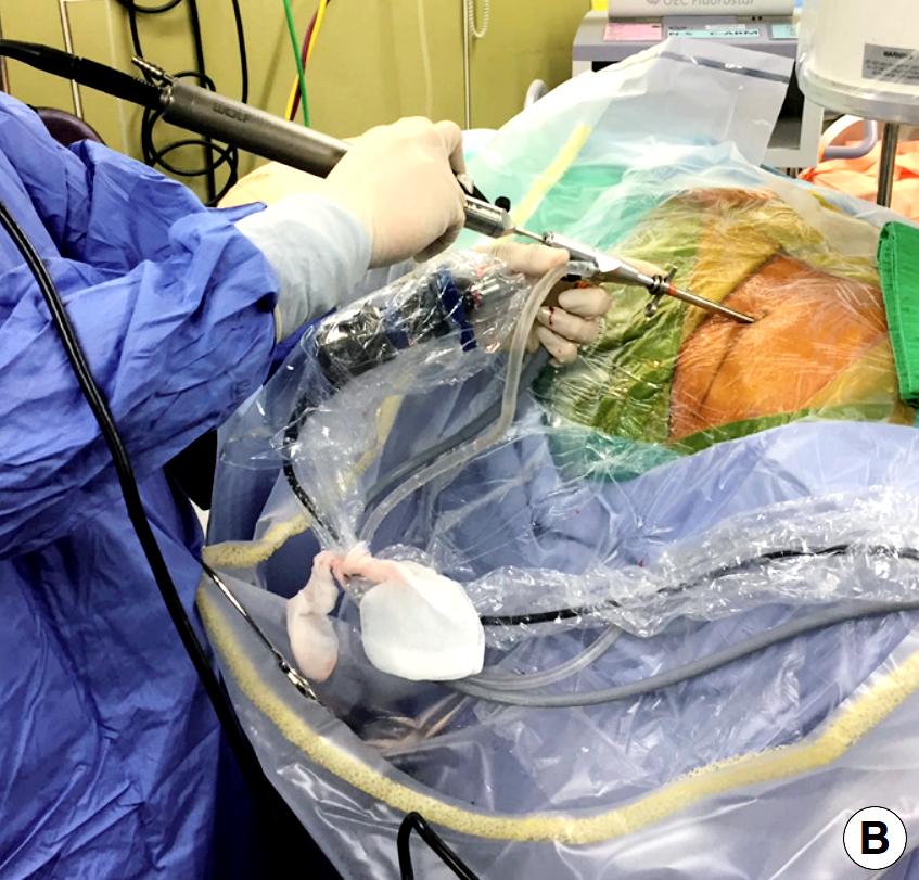 椎间孔镜微创介入治疗椎间盘突出,腰3-4椎间盘突出针刀治疗