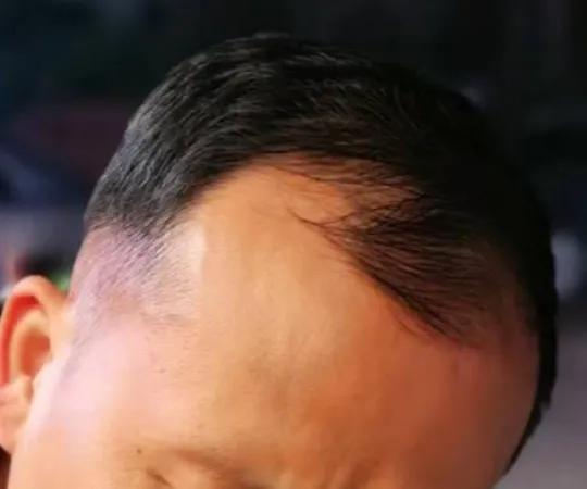 男士植发过来人真实感受,16000字讲述植发真实感受