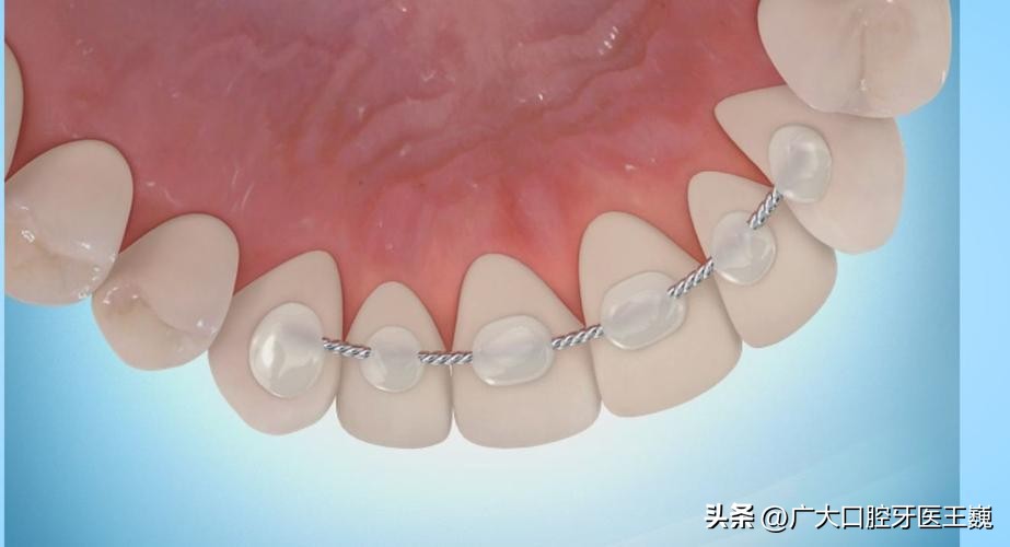 牙齿正畸过程中需要注意什么事项,正畸后要种牙怎么戴正畸保持器