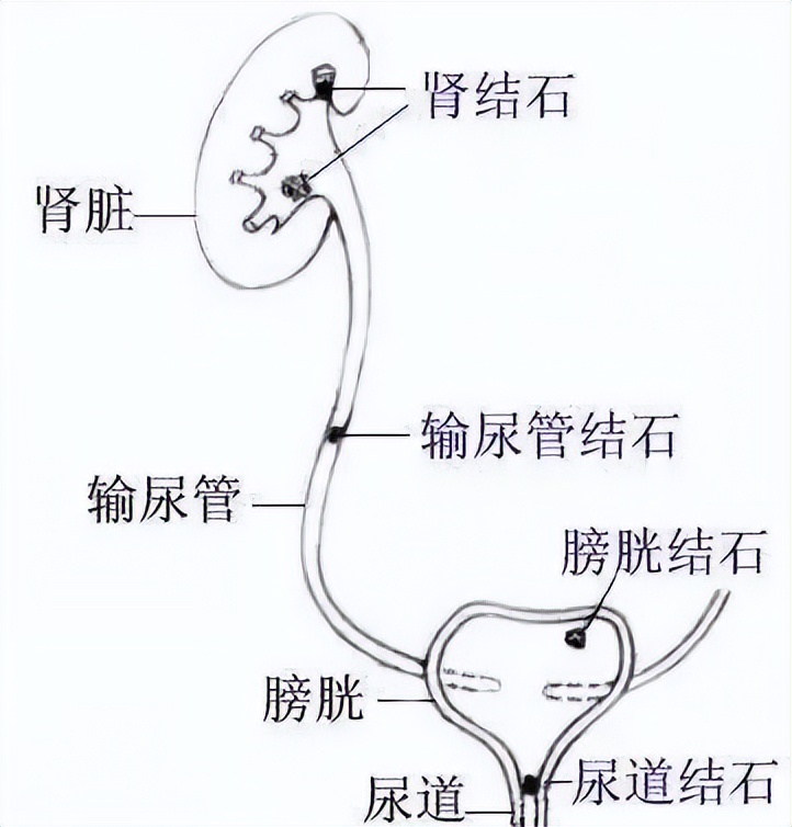 如何预防泌尿系统结石,对于泌尿系结石最有效的预防方法