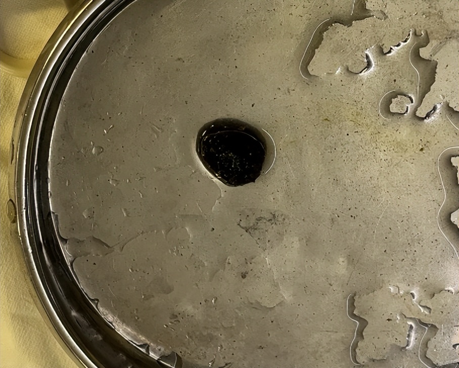 胆结石保胆取石哪家医院做的最好,四川胆结石医院排名