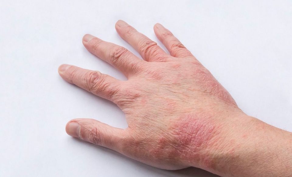 吃了中药湿疹冒得更多是什么原因,湿疹反反复复用什么中药治疗最好