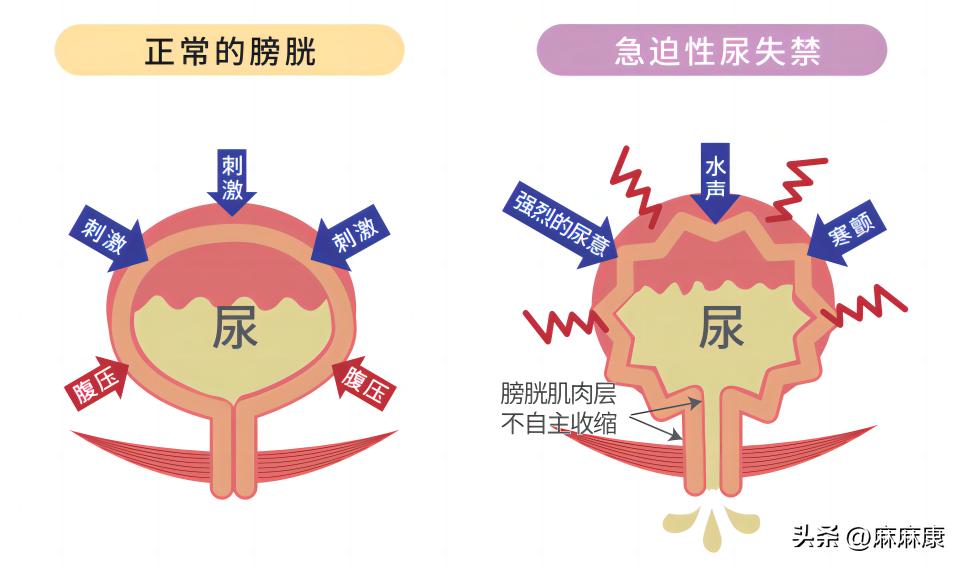 盆底肌紧张慢性盆腔痛,憋不住小便的时候盆底肌疼