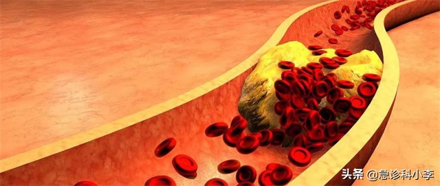 睡觉时突然腿抽筋是缺钙引起的吗,睡觉腿抽筋除了缺钙还有3个原因