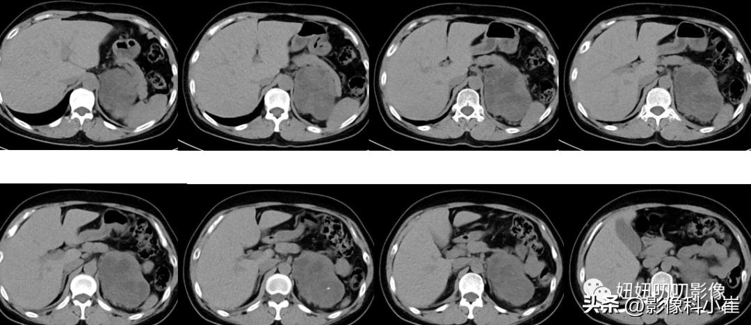 肾上腺疾病的诊断思路,肾上腺可能出现的病症有哪些