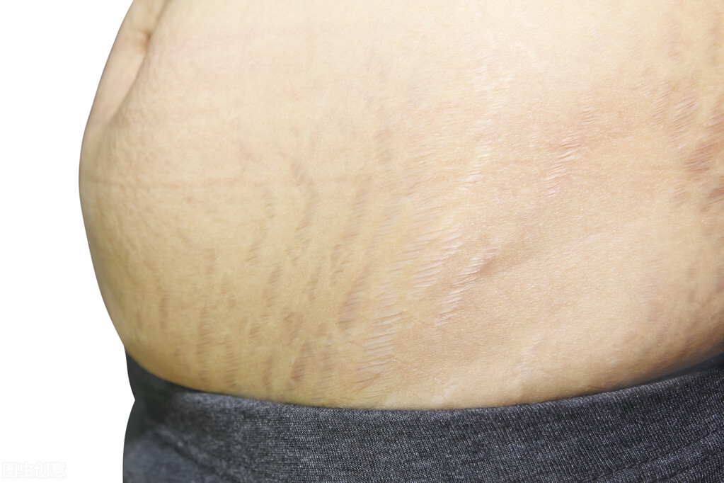 孕期去除妊娠纹最好的办法,孕妇专用妊娠纹去除最好的办法