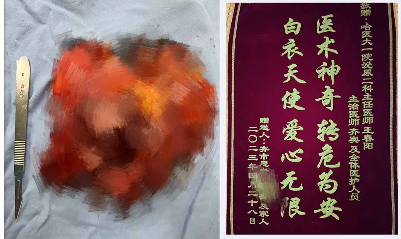 哈医大一院泌尿外科王春阳,哈医大一院泌尿外科王春阳教授