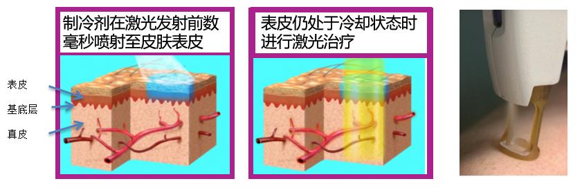 做祛红激光治疗疤痕后的护理,pdl激光治疗红血丝效果好吗