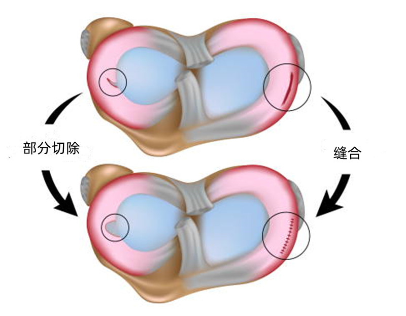 半月板撕裂应该缝合还是切除,半月板撕裂后是切除好还是缝合好