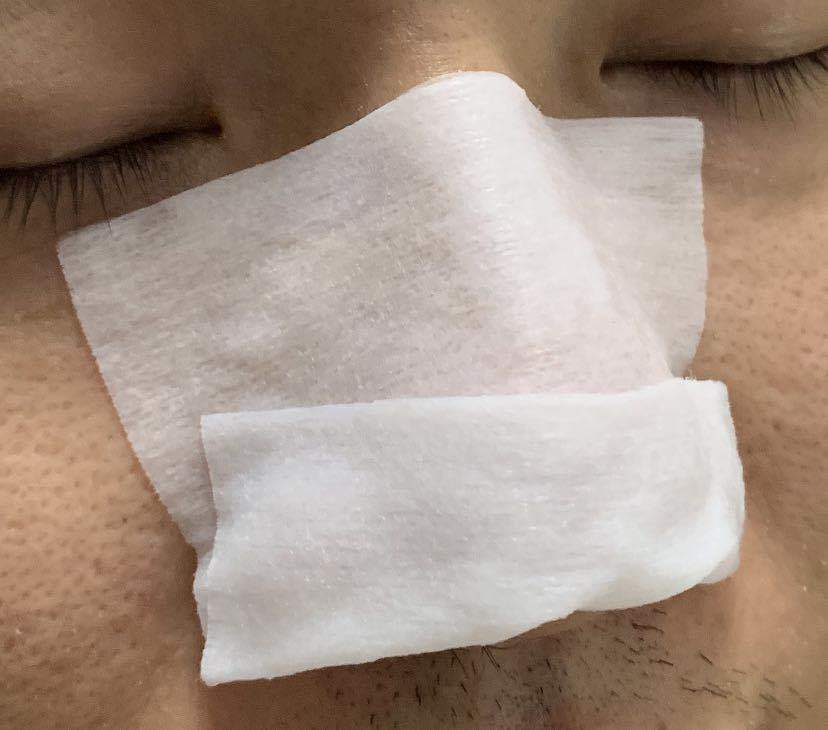 鼻子毛孔大能挤出好多脂肪粒,鼻子上长了像脂肪粒的东西