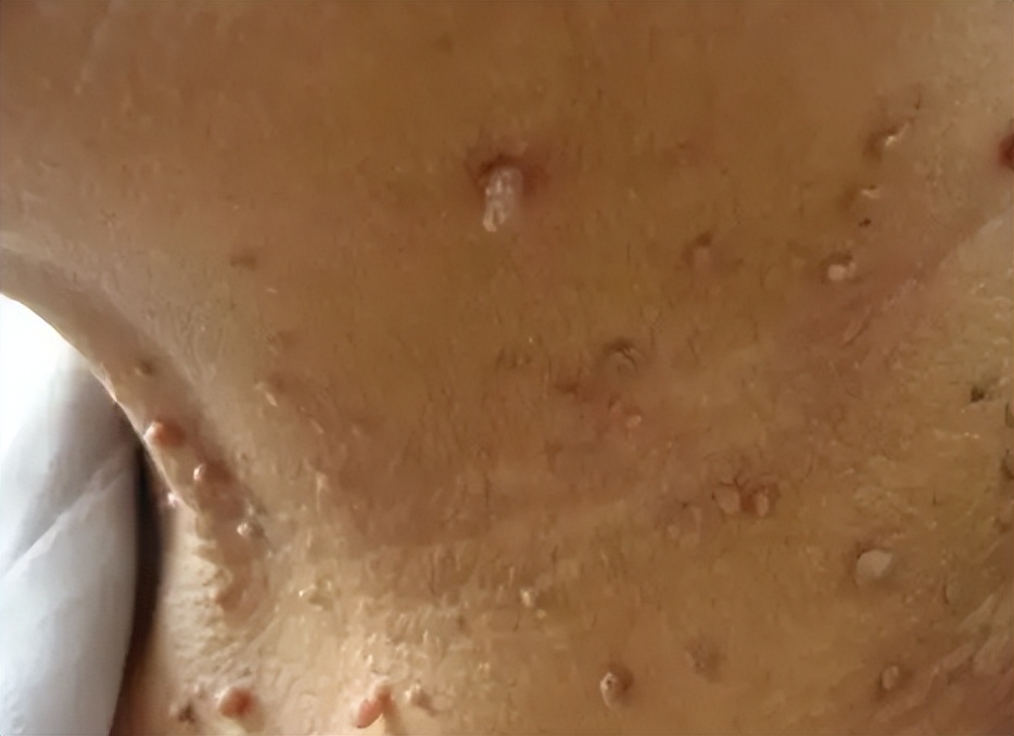 皮肤长了个凸起的小肉球怎么去除,皮肤长的小肉球怎么自己处理