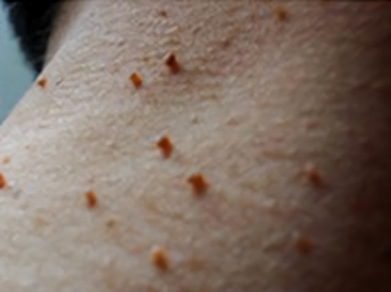 脖子腋下长小肉粒可以用手揪掉吗,脖子旁边出现小肉粒能直接揪掉吗