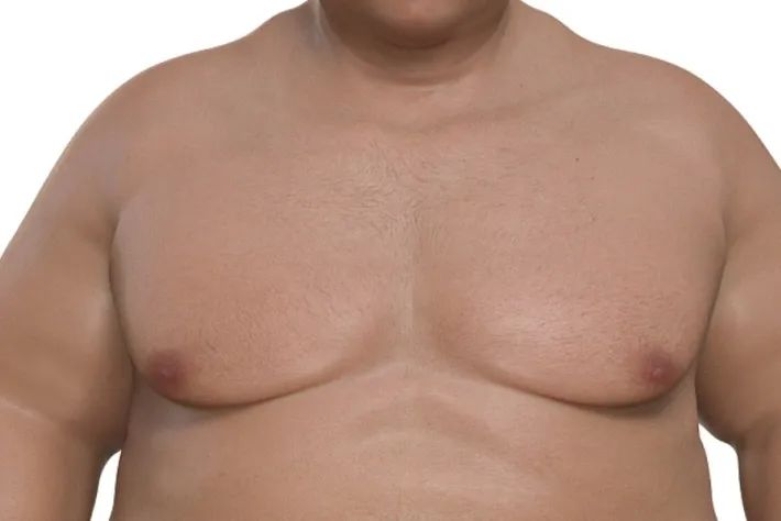 男性会患乳腺增生吗,男性会得乳腺增生吗