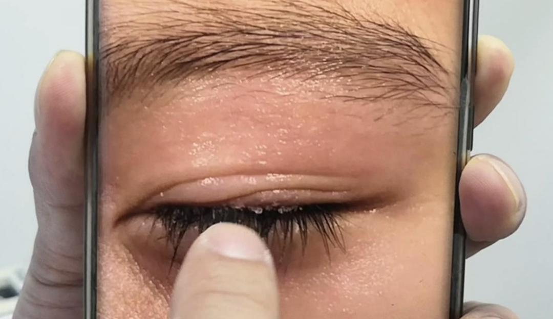 502不小心溅到眼睛里了怎么办,502溅了一点点进眼睛里了怎么办