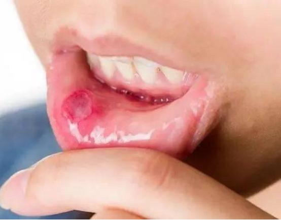 口腔溃疡有可能是梅毒,口腔溃疡长期不好是因为梅毒吗