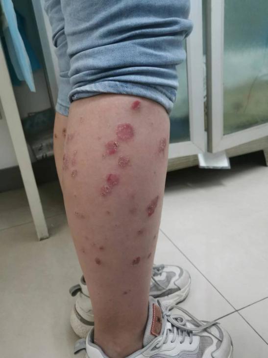 【门诊医讯】河北省人民医院皮肤科专病门诊——银屑病门诊