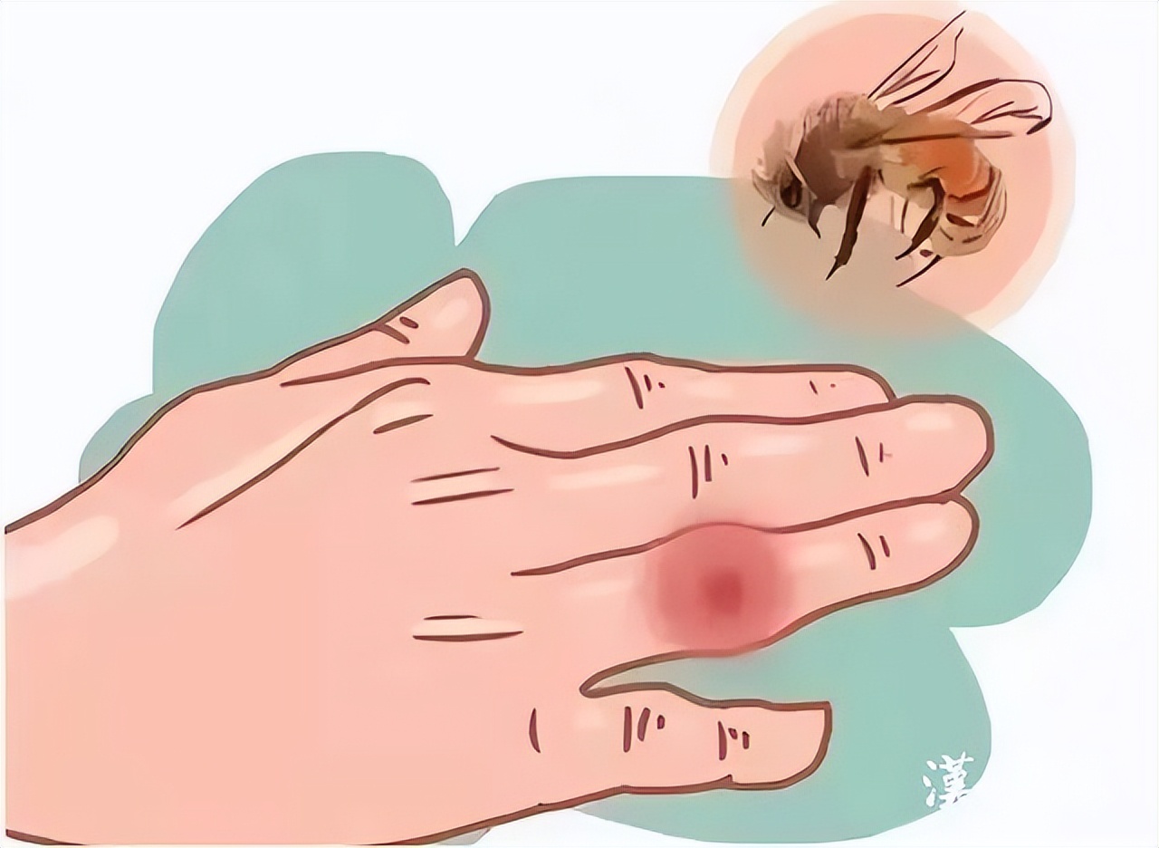 被蜂蜇伤后的4个自救方法,被黄蜂蛰伤应第一时间怎么处理