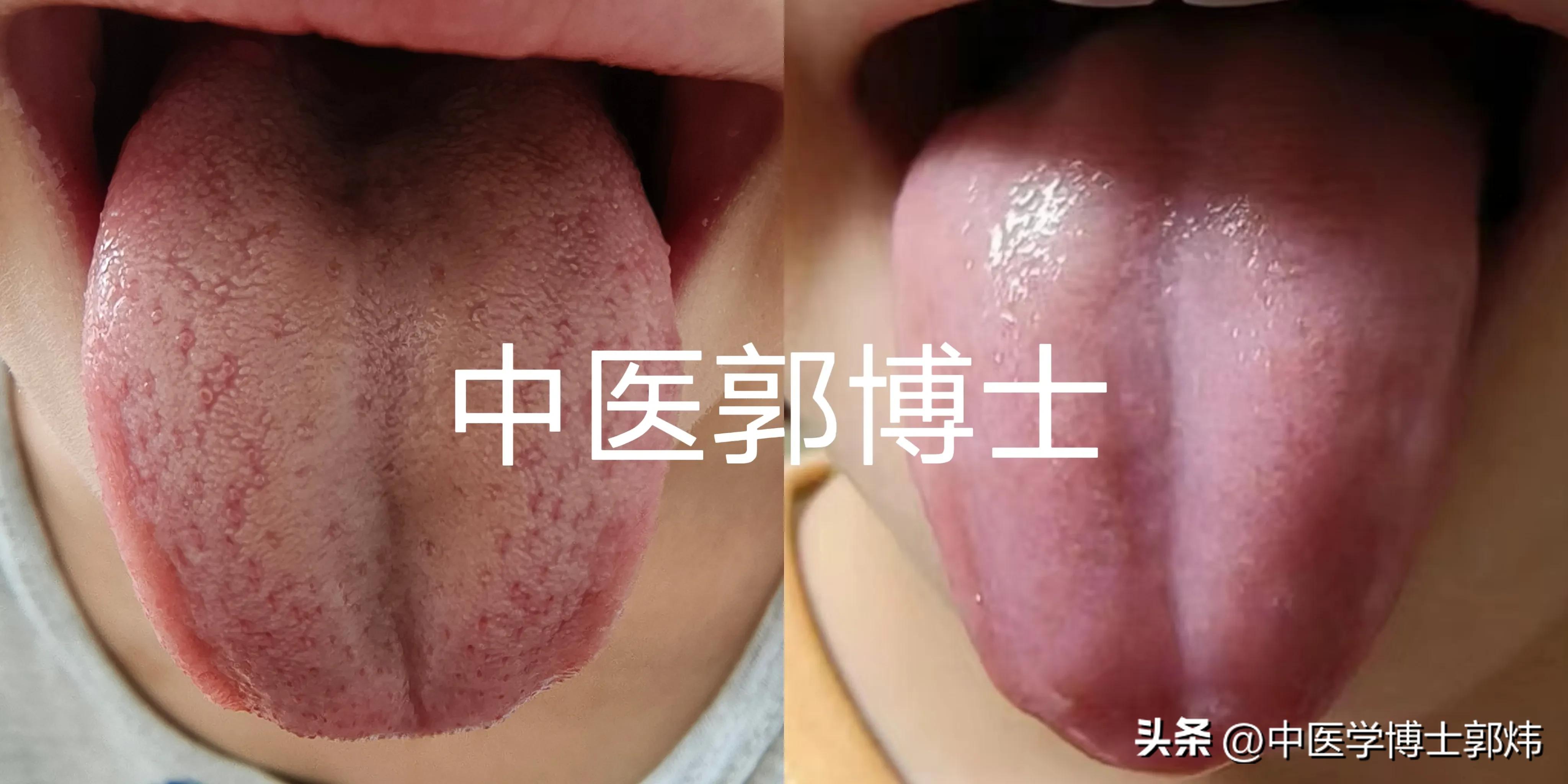 孩子不爱吃饭，愁坏多少家长，中药调理简单，疗效看看舌苔