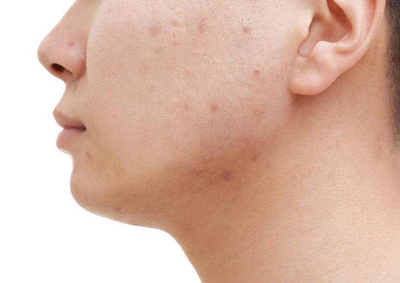 脸上长痘痘后，痘印怎么消除？推荐：这4个方法或能减少痘印